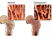 پوکی استخوان و مقابله با آن